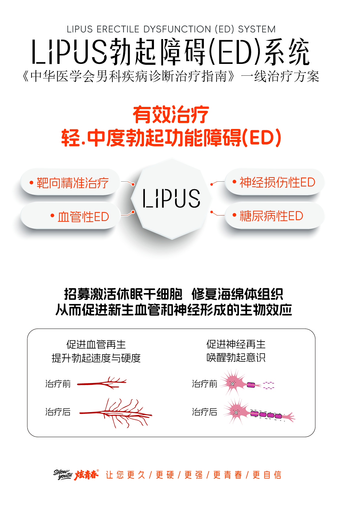 杭州炫青春男仕抗衰中心LIPUS ED系统,为男科指南一线轻中度ED治疗方案